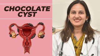 What Is Chocolate Cyst  Chocolate Cyst Ovarian Endometrioma  Cause  Symptoms  Treatment [upl. by Schwartz743]