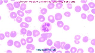 Hyper segmented Neutrophils due to Hydroxycarbamide [upl. by Meeharb]