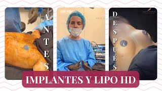 Colocación de IMPLANTES y LIPO HD Esculpiendo el Cuerpo con Resultados de Alta Definición [upl. by Dlareme]