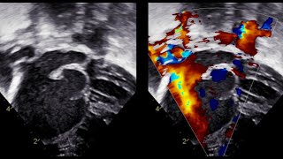 Total Anomalous Pulmonary Venous Return quot TAPVR quot Echo Study [upl. by Llerrat662]