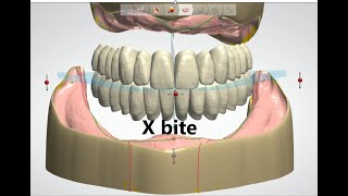 Crossbite setup in 3Shape [upl. by Vanhook167]