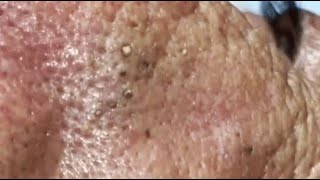 WOOW  A PILE OF BLACKHEADS IN THE NOSE OF AN ELDERLY MAN😨 relaxing blackheads [upl. by Jerrold]