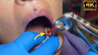 Abscessed Tooth Extraction in 1 MIN or less in 4K [upl. by Akitnahs]