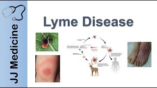 Lyme Disease  Pathophysiology Signs and Treatment [upl. by Tiffi706]