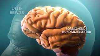 Alzheimers Sygdom Understanding Alzheimers Disease [upl. by Nelli391]