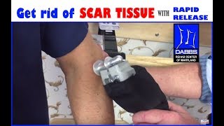 How to get rid of SCAR TISSUE with Rapid Release High Frequency Vibration [upl. by Mcallister194]