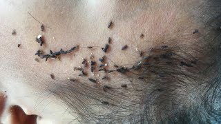 How to clear a lot of head lice  Pick out a thousand head lice from long hair [upl. by Weinreb]