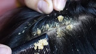 Dandruff scratching removal on head using black combing235 [upl. by Adlare]