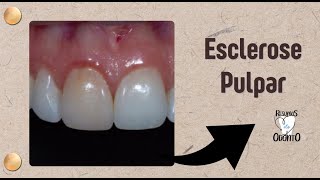 ESCLEROSE PULPAR  RESUMOS DE ODONTO [upl. by Akenot]