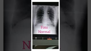 CARA MEMBEDAKAN ABNORMAL DAN NORMAL FOTO THORAX RONTGEN [upl. by Thynne106]