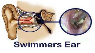 How to Get Rid of Swimmers Ear Fast [upl. by Esinyl]