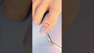 How Toenail Removal Works 😱 shortsfeed [upl. by Airdnassac]