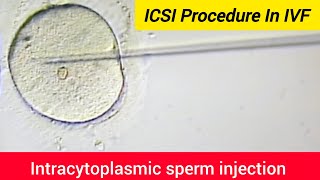 ICSI Procedure in IVF  Intracytoplasmic sperm injection  Assisted Reproductive Technology ICSI [upl. by Hsirrap]