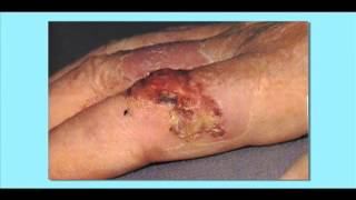 Squamous Cell Carcinoma Skin Cancer [upl. by Anayt]