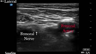 Ultrasound Guided Femoral Nerve Block with Catheter Placement [upl. by Karlens376]