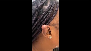 🦻🏾🦻🏾What the hll is that on your ear🙉Helical keloids in Black skin [upl. by Noelc868]