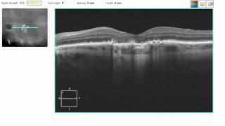 OCT Tutorial Geographic Atrophy in Dry AMD [upl. by Nairde985]