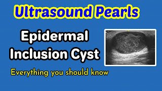 Ultrasound Pearls Epidermal inclusion cyst [upl. by Annawaj]