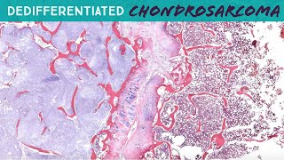 Dedifferentiated Chondrosarcoma with osteosarcoma heterologous area  hemipelvectomy UNC case 7 [upl. by Hummel766]