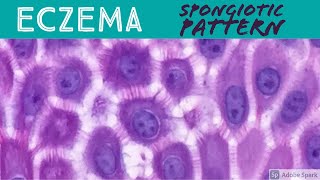 EczemaAtopic Contact Dermatitis etc Spongiotic Dermatitis Pattern  Inflammatory Dermpath Basics [upl. by Sosna]