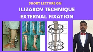 ILIZAROV TECHNIQUE FRACTURE TREATMENT WITH EXTERNAL FIXATION FRACTURE SURGICAL MANAGEMENT [upl. by Arracat966]