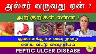 PEPTIC ULCER  SYMPTOMS CAUSES AND TREATMENT IN TAMIL FOODS TO CURE ULCER வயிற்றுப்புண் [upl. by Alul314]