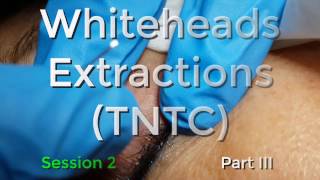 Whiteheads Extraction TNTC  Session 2 Part 3 of 3 [upl. by Collum805]