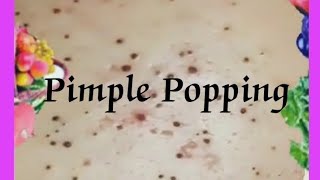 Pimple amp Blackheads Popping  52 [upl. by Fanchet]