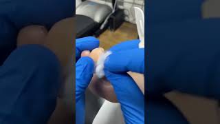 Watch a Podiatrist Expertly Remove a Big Toe Callus with Scalpel [upl. by Assilav396]