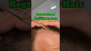 This Is How I Have Been Regrowing My Hair When Fighting Androgenetic Alopecia [upl. by Tdnaltroc]