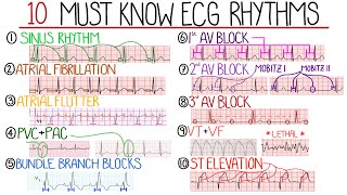 Most Common ECG Patterns You Should Know [upl. by Adelia]