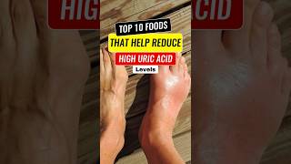 ✅Top 10 Foods To Reduce High Uric Acid Levels Uric acid diet Gout diet [upl. by Jerrylee]