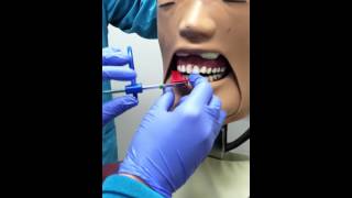 premolar bitewing radiograph [upl. by Goodrow983]