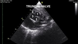 Truncus Arteriosus Echocardiography [upl. by Glendon276]