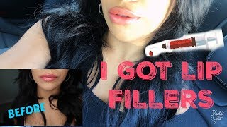 MY FIRST TIME JUVEDERM VOLLURE LIP FILLERS [upl. by Ranitta]