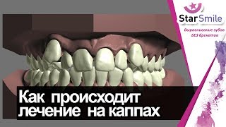 Как исправить скученность зубов Пошаговый план перемещения зубов в элайнерах [upl. by Aihsiym]