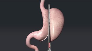 Animation of Sleeve Gastrectomy with Titan SGS™ [upl. by Shewmaker]