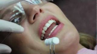 Invisalign Video Blog Bonding Attachments HD  Sierra 05 [upl. by Gnaig948]