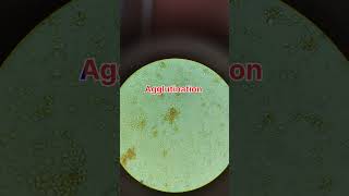 Cross match blood reaction when two different blood samples mixsimple way of cross match [upl. by Yelha]