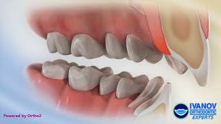 Teeth Before and After Overbite Fix with Braces [upl. by Zinnes]