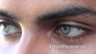 Eye color change surgery 3 months post op  brightocular [upl. by Auj]