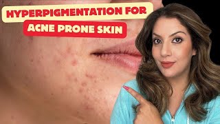 Effective Hyperpigmentation Treatment for Acne Prone Skin  Clear Your Skin Fast  Nipun Kapur [upl. by Abla]