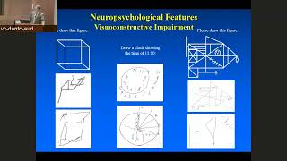 Lewy Body Dementia Update Diagnosis Management and Future Directions [upl. by Tarttan678]