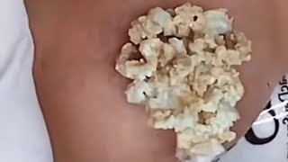 Pimples huge blackheads and pimple poppingbest pimple popping video [upl. by Asilam]