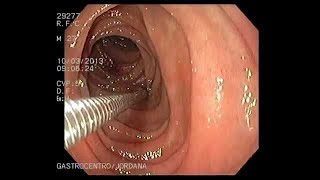 Como é feito o exame de endoscopia digestiva alta [upl. by Angadresma]