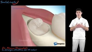 estrazione del dente del giudizio dente incluso tooth extraction  Clinica Merli Rimini [upl. by Windzer]