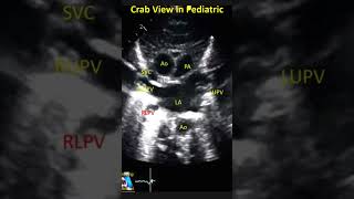 Crab view pediatric Echo [upl. by Rosenberg326]