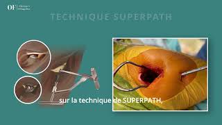 Prothèse totale de hanche par technique mini invasive Superpath présentation par le Dr OFontes [upl. by Jackquelin]