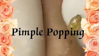 Pimple amp Blackheads Popping  27 [upl. by Sonafets]