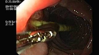 Best Gastro Clinic Chennai Gastroenterology problems treated with Laser [upl. by Allegna361]